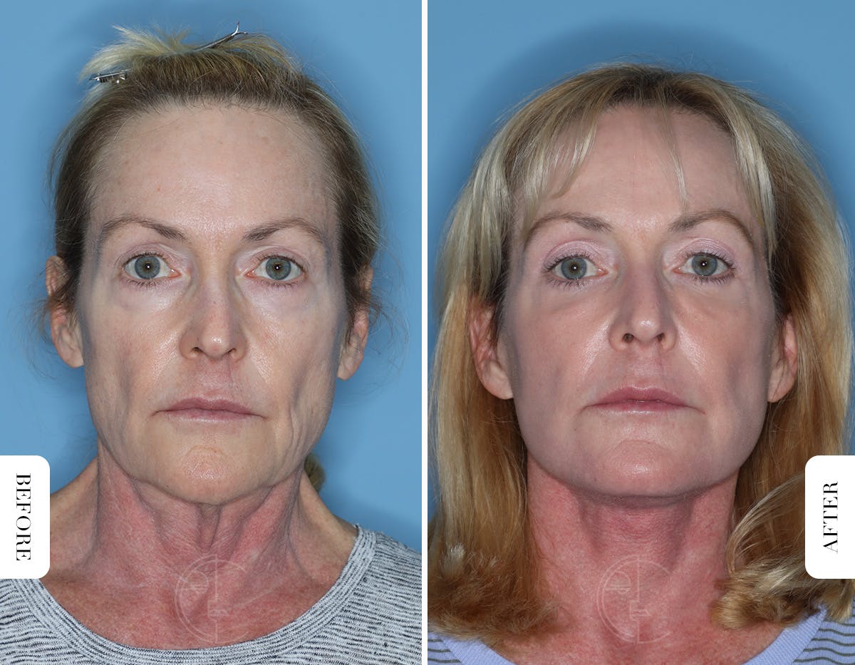 Miami Lower Eyelid Lift Before & After Gallery - Patient 322158 - Image 1 - The Chopra Plastic Surgery Center