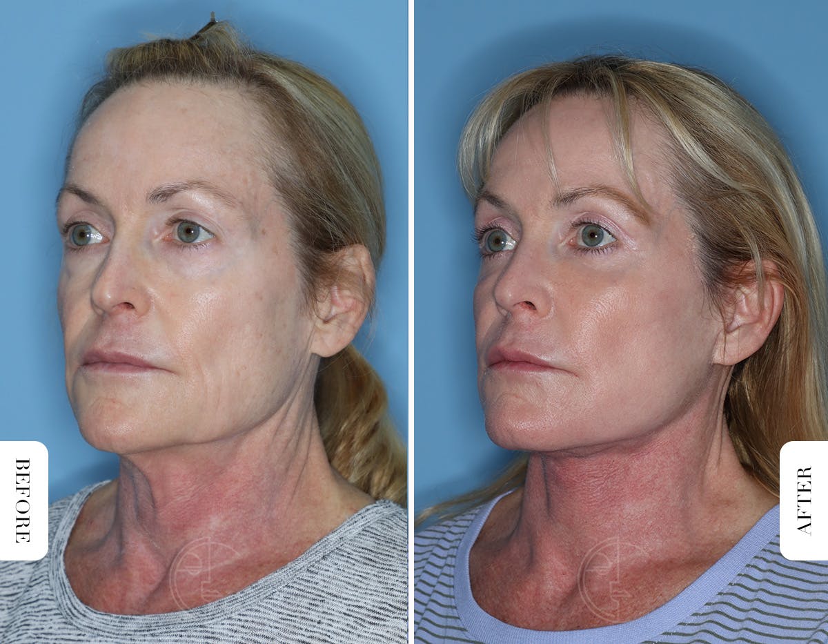 Miami Lower Eyelid Lift Before & After Gallery - Patient 322158 - Image 4 - The Chopra Plastic Surgery Center