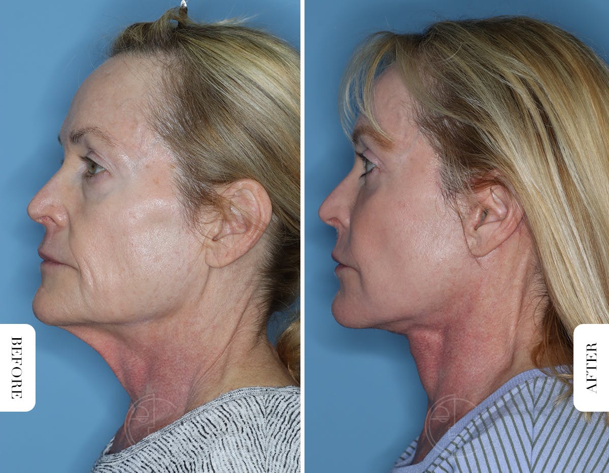 Miami Lower Eyelid Lift Before & After Gallery - Patient 322158 - Image 5 - The Chopra Plastic Surgery Center