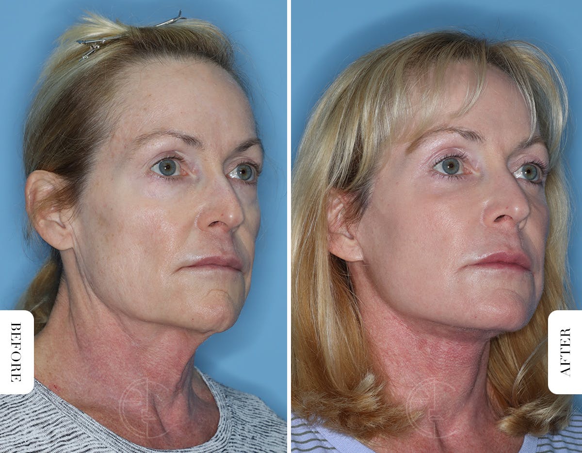 Miami Lower Eyelid Lift Before & After Gallery - Patient 322158 - Image 2 - The Chopra Plastic Surgery Center