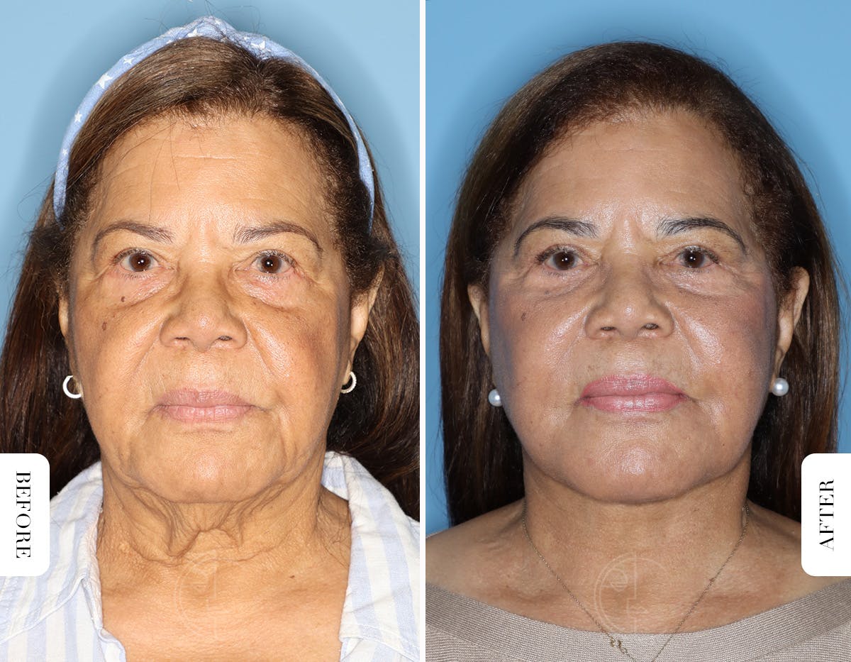 Miami Lower Eyelid Lift Before & After Gallery - Patient 177142 - Image 1 - The Chopra Plastic Surgery Center