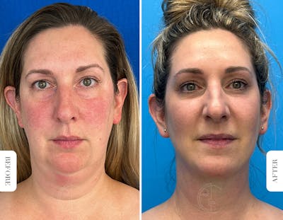Miami Facelift/Neck Lift Before & After Gallery - Patient 329163 - Image 1 - The Chopra Plastic Surgery Center