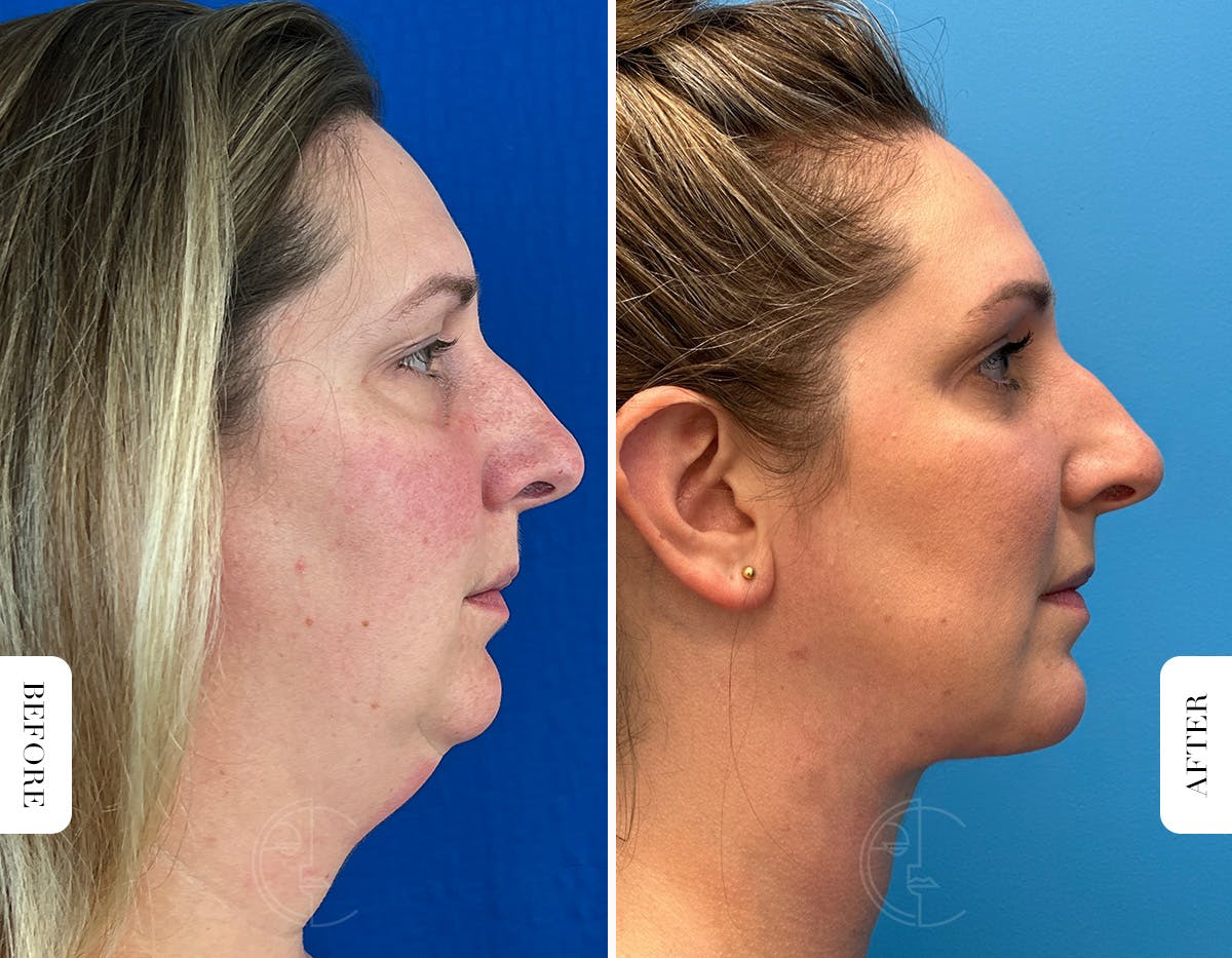 Miami Lower Eyelid Lift Before & After Gallery - Patient 804869 - Image 3 - The Chopra Plastic Surgery Center