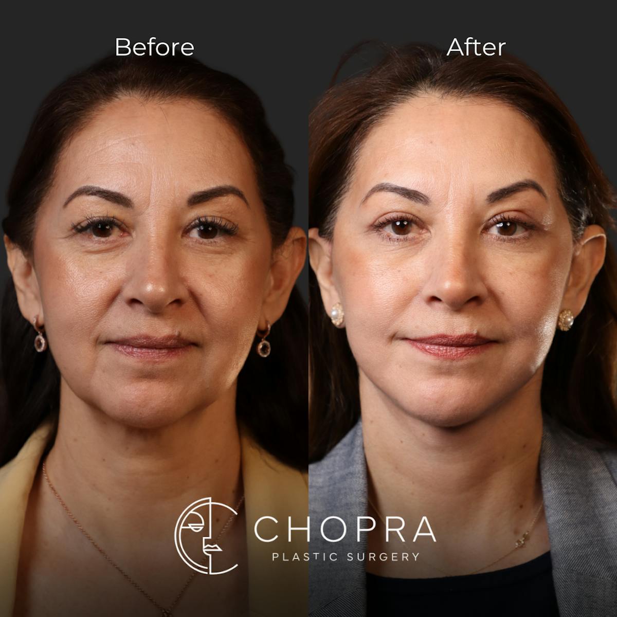 Miami Facelift/Neck Lift Before & After Gallery - Patient 107464 - Image 1 - The Chopra Plastic Surgery Center