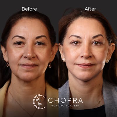 Miami Facelift/Neck Lift Before & After Gallery - Patient 107464 - Image 1 - The Chopra Plastic Surgery Center