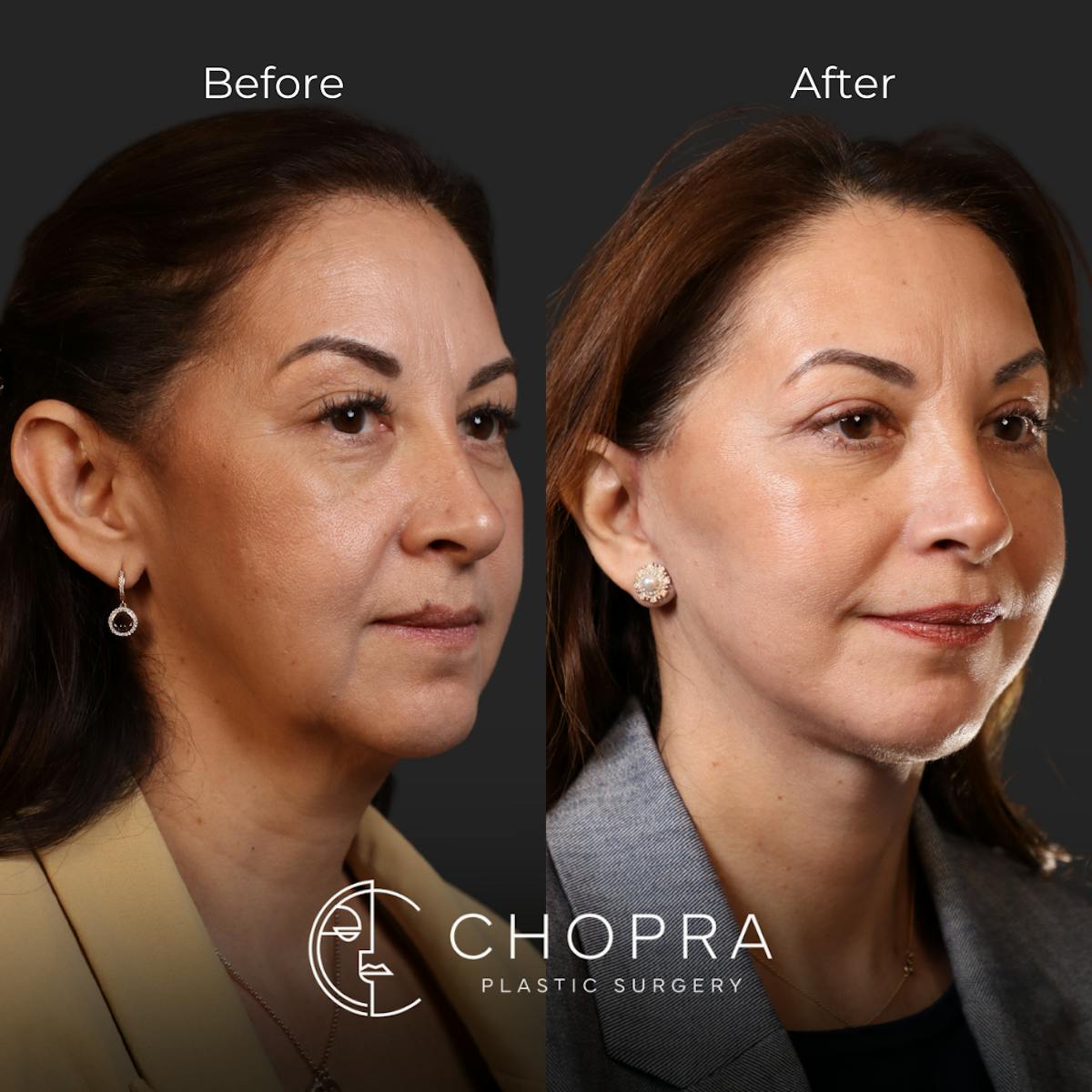 Miami Facelift/Neck Lift Before & After Gallery - Patient 107464 - Image 2 - The Chopra Plastic Surgery Center