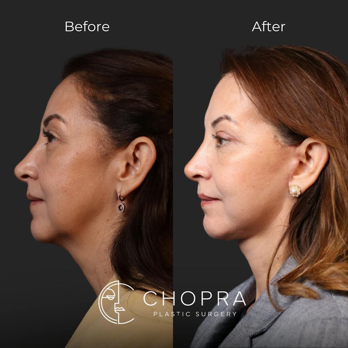 Miami Facelift/Neck Lift Before & After Gallery - Patient 107464 - Image 4 - The Chopra Plastic Surgery Center