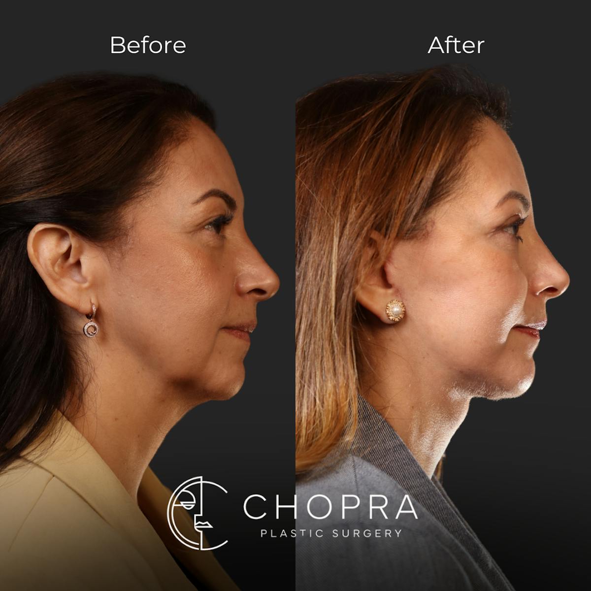 Miami Facelift/Neck Lift Before & After Gallery - Patient 107464 - Image 3 - The Chopra Plastic Surgery Center