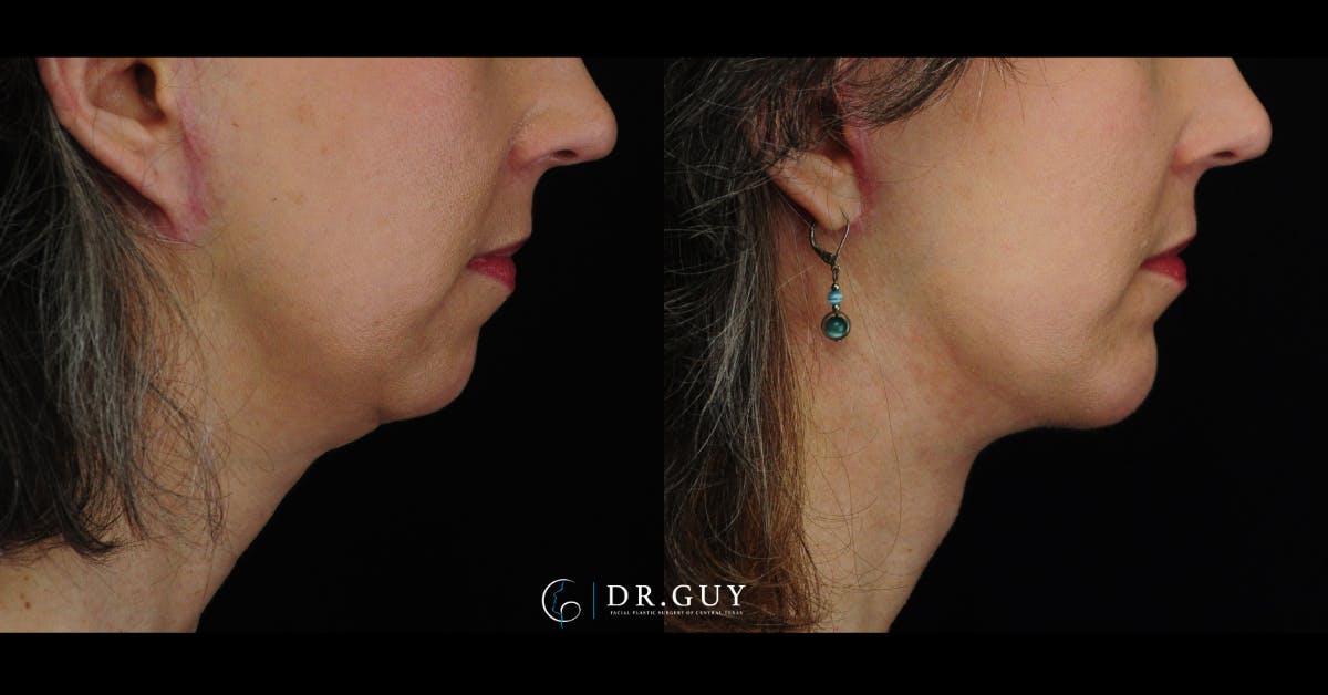Facelift Before & After Gallery - Patient 360344 - Image 3