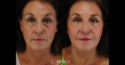 Facelift Before & After Gallery - Patient 340907 - Image 1