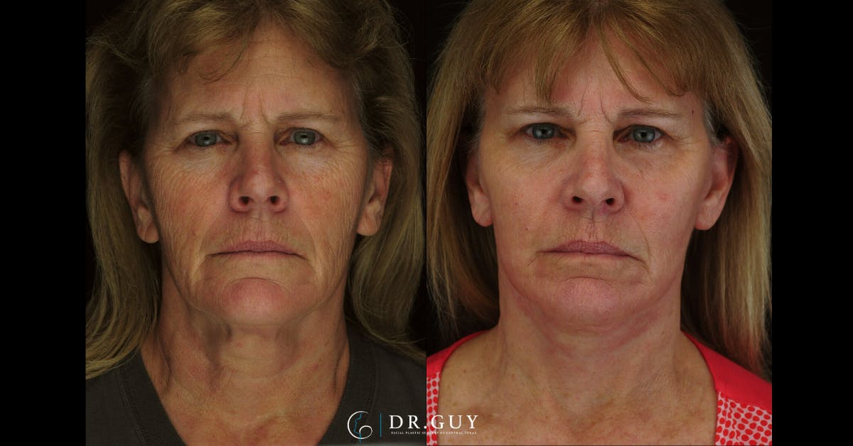 Facelift Before & After Gallery - Patient 310670 - Image 3