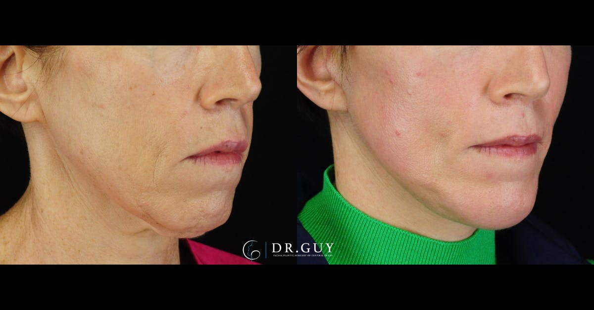 Mini Facelift Before & After Gallery - Patient 416662 - Image 3