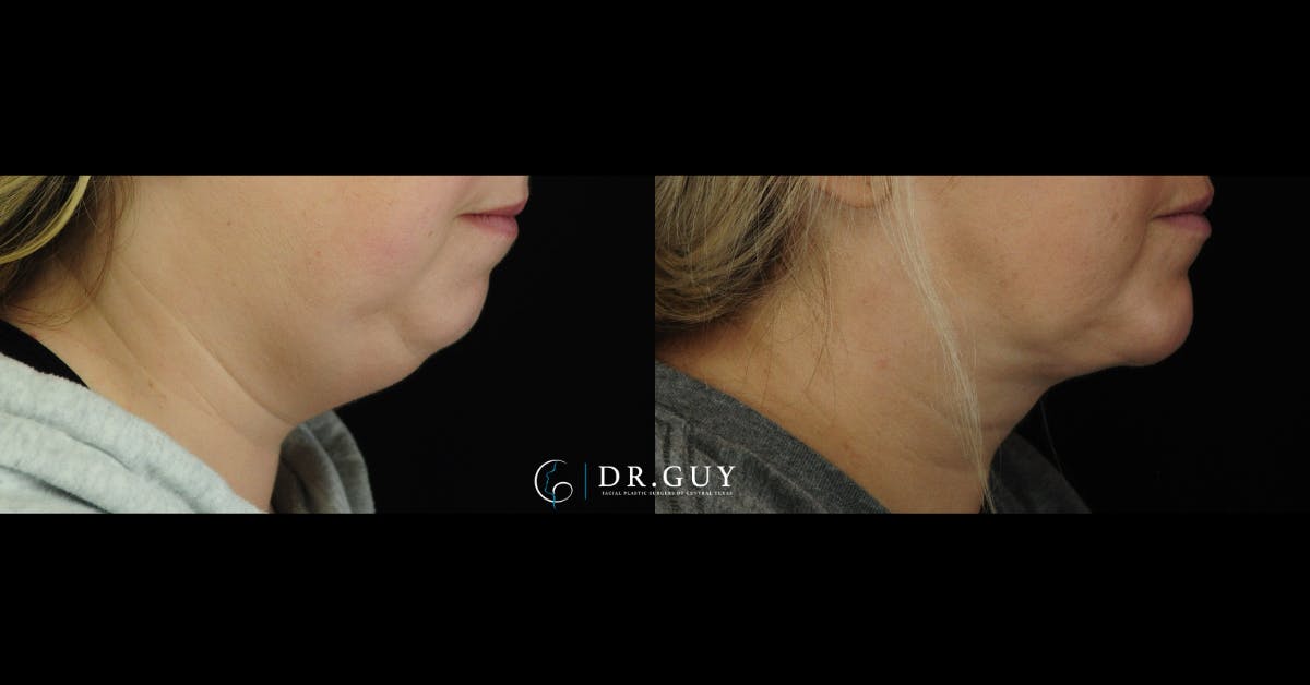 Neck Liposuction Before & After Gallery - Patient 101143 - Image 4