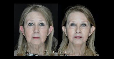 Lip Lift Before & After Gallery - Patient 122229 - Image 1