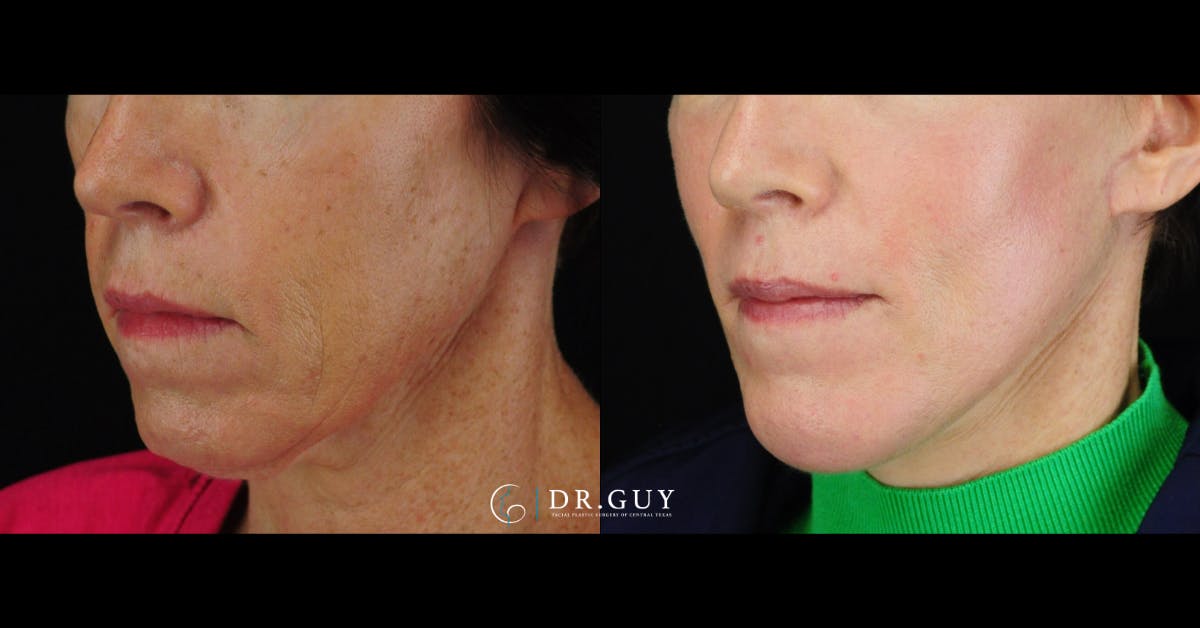 Chin Before & After Gallery - Patient 343009 - Image 4