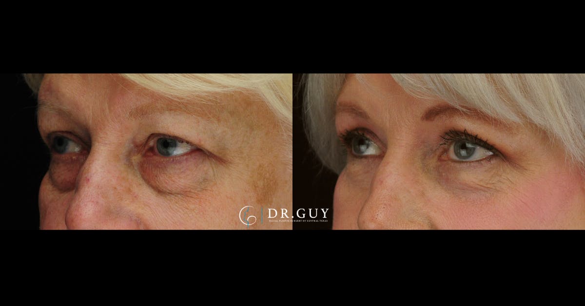 Lower Blepharoplasty Before & After Gallery - Patient 384679 - Image 1