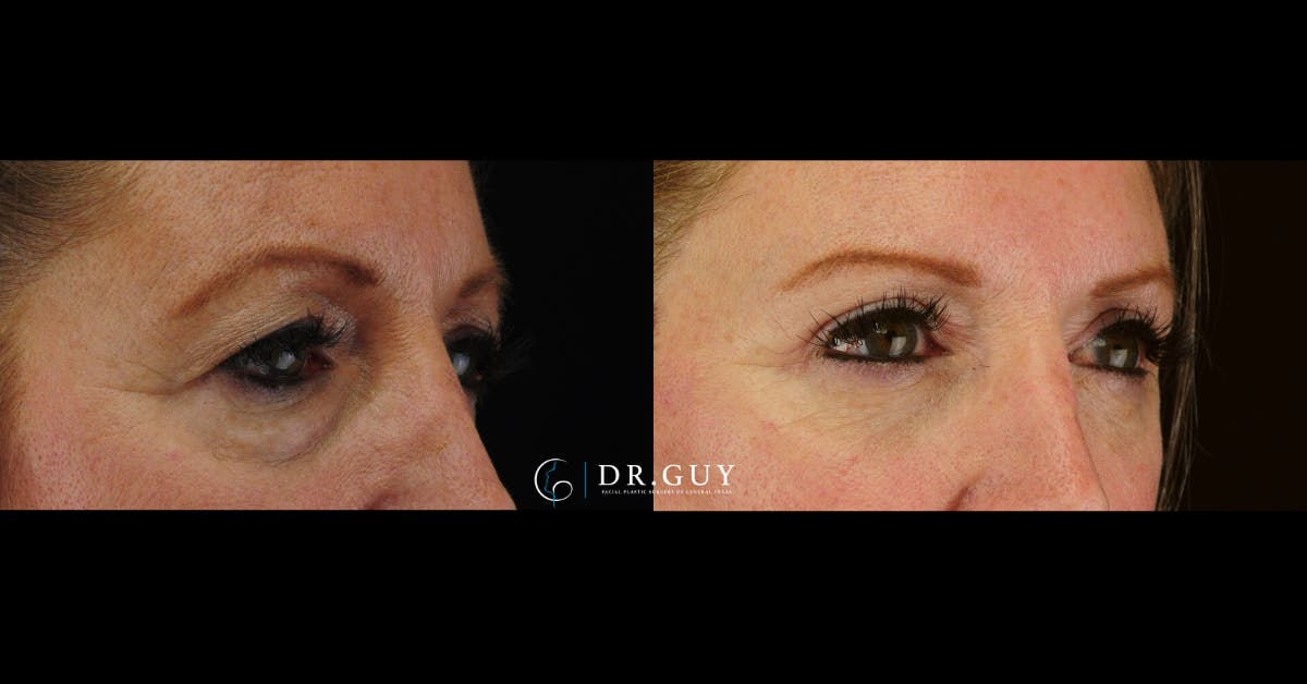 Lower Blepharoplasty Before & After Gallery - Patient 327769 - Image 2