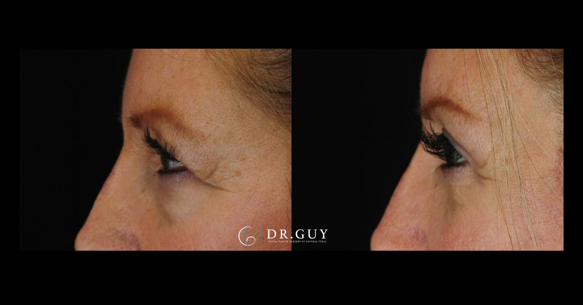 Lower Blepharoplasty Before & After Gallery - Patient 327769 - Image 4