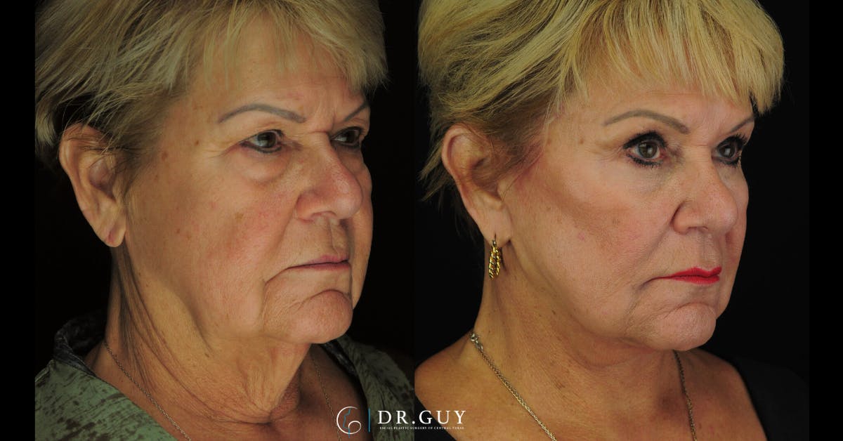 Browlift Before & After Gallery - Patient 388018 - Image 4