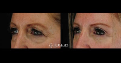 Browlift Before & After Gallery - Patient 412780 - Image 1