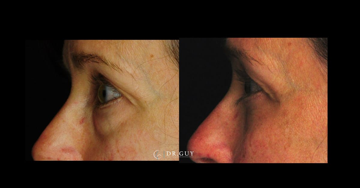 Browlift Before & After Gallery - Patient 251117 - Image 4