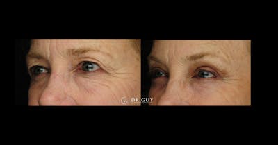 Browlift Before & After Gallery - Patient 185601 - Image 1