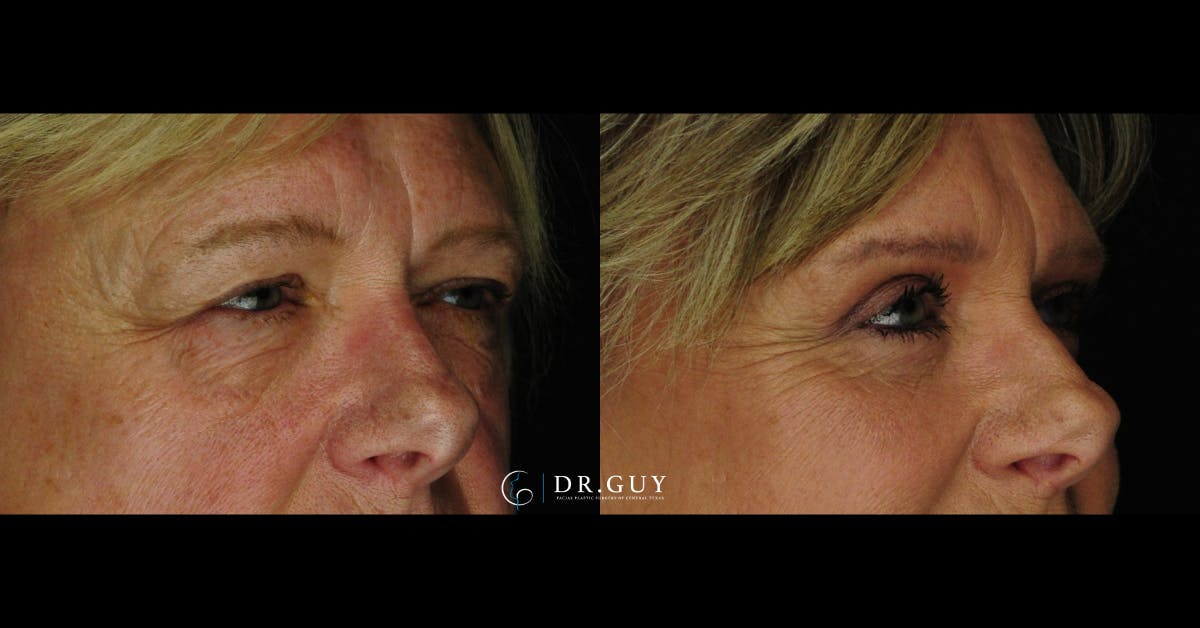 Lower Blepharoplasty Before & After Gallery - Patient 386958 - Image 4