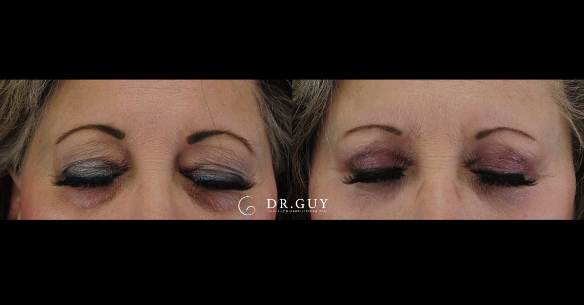 Upper Blepharoplasty Before & After Gallery - Patient 246240 - Image 4