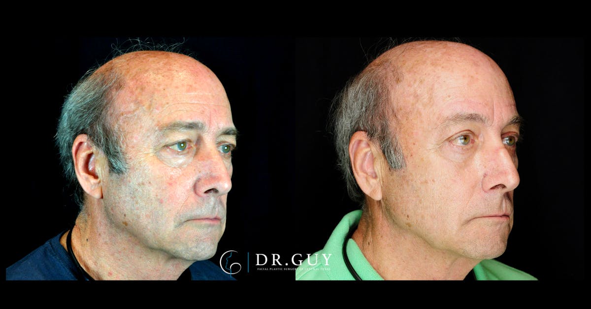 Browlift Before & After Gallery - Patient 333254 - Image 2