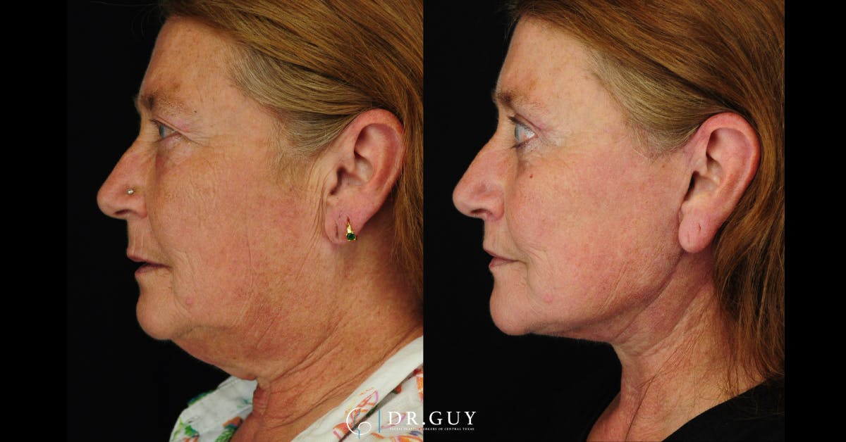 Upper Blepharoplasty Before & After Gallery - Patient 149206 - Image 5