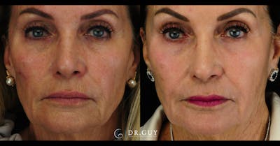 Chemical Peels Before & After Gallery - Patient 398814 - Image 1