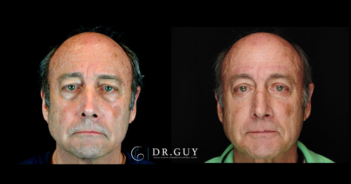Fat Grafting Before & After Gallery - Patient 296944 - Image 1