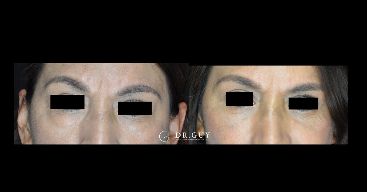 Fat Grafting Before & After Gallery - Patient 191699 - Image 3