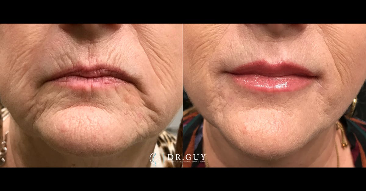 Fillers Before & After Gallery - Patient 245643 - Image 1