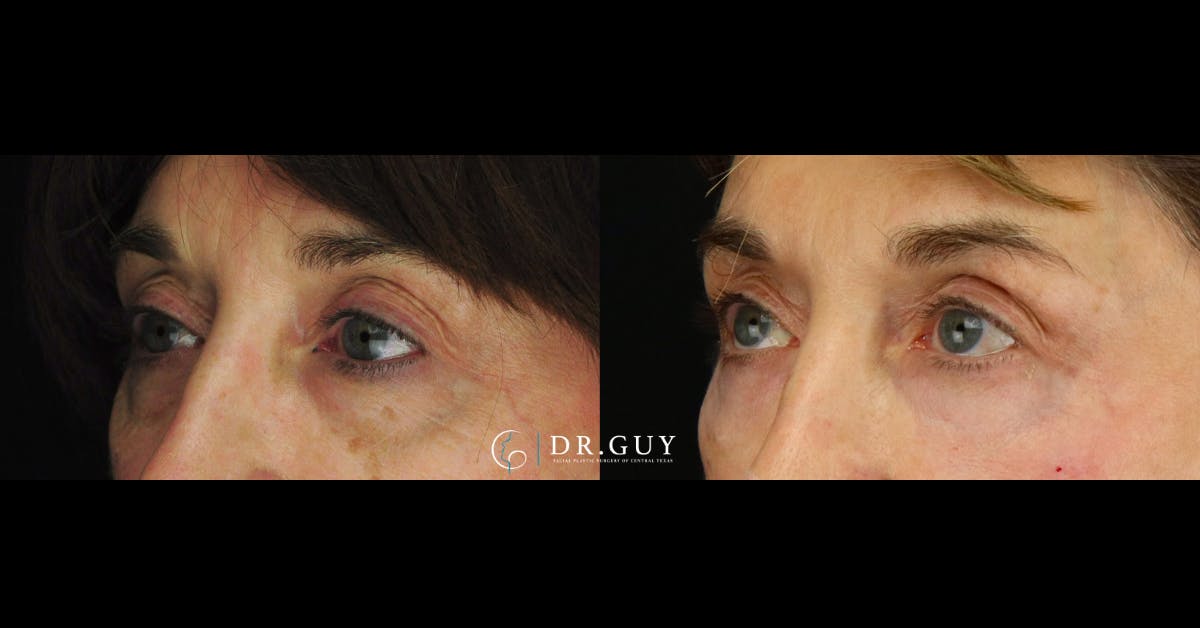 Fillers Before & After Gallery - Patient 385324 - Image 1