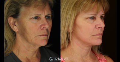Laser Before & After Gallery - Patient 213737 - Image 1