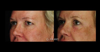 Upper Blepharoplasty Before & After Gallery - Patient 256947 - Image 1