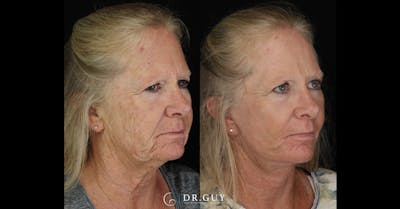 Facelift Before & After Gallery - Patient 330561 - Image 1