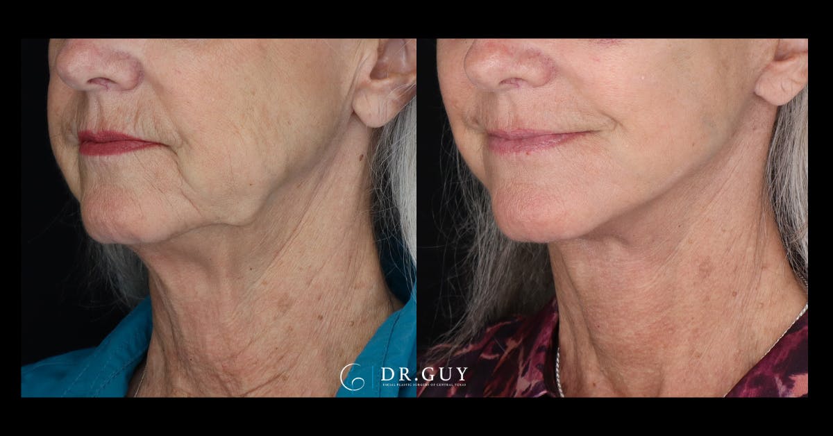 Facelift Before & After Gallery - Patient 680592 - Image 5