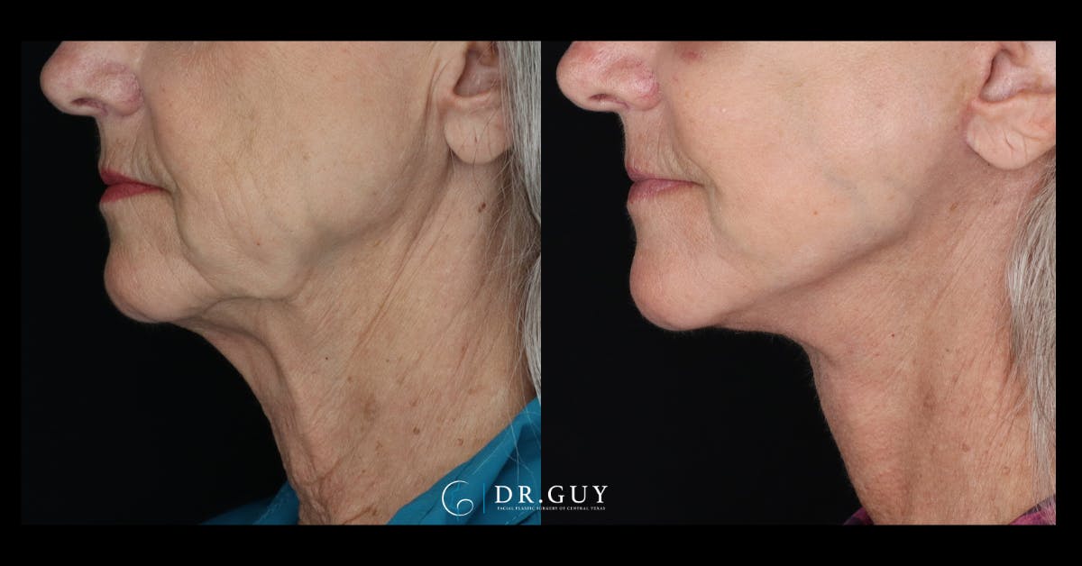 Facelift Before & After Gallery - Patient 680592 - Image 4