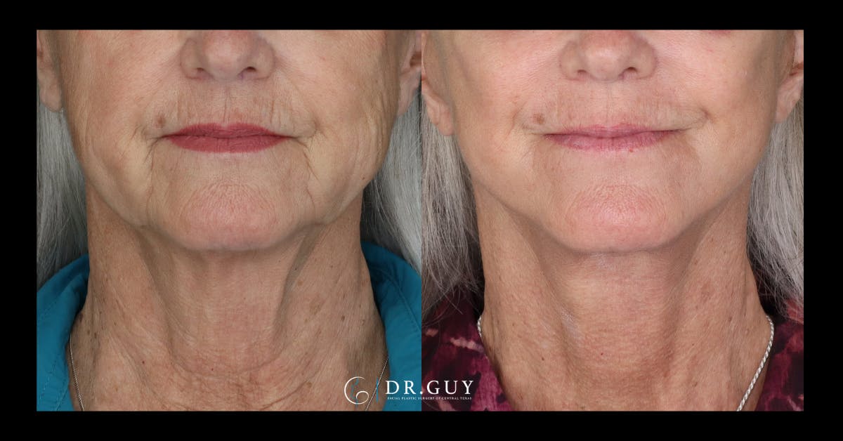 Facelift Before & After Gallery - Patient 680592 - Image 3