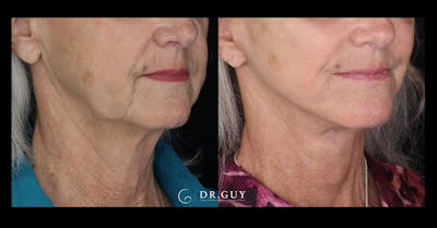 Facelift Before & After Gallery - Patient 680592 - Image 1
