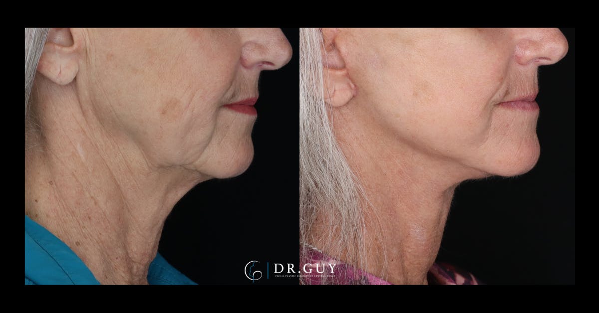 Facelift Before & After Gallery - Patient 680592 - Image 2