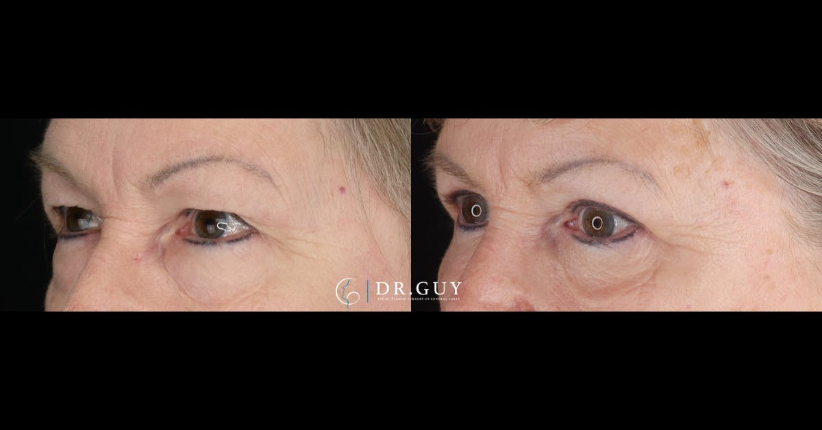 Upper Blepharoplasty Before & After Gallery - Patient 427775 - Image 2