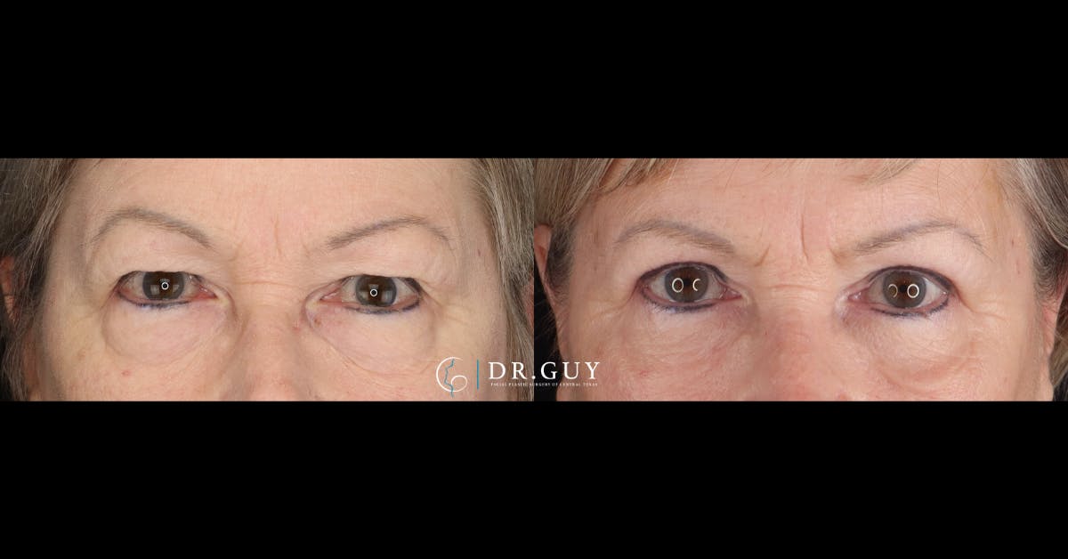 Upper Blepharoplasty Before & After Gallery - Patient 427775 - Image 1