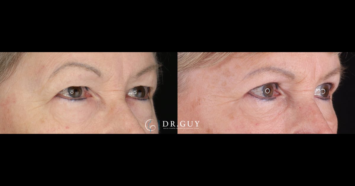 Upper Blepharoplasty Before & After Gallery - Patient 427775 - Image 3