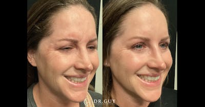 Neuromodulators Before & After Gallery - Patient 532720 - Image 1