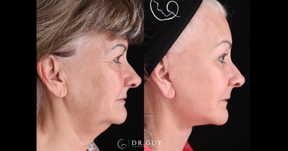 Facelift Before & After Gallery - Patient 558043 - Image 3