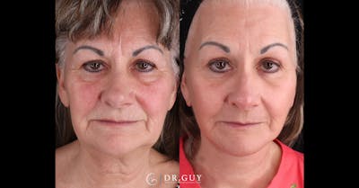 Facelift Before & After Gallery - Patient 558043 - Image 1