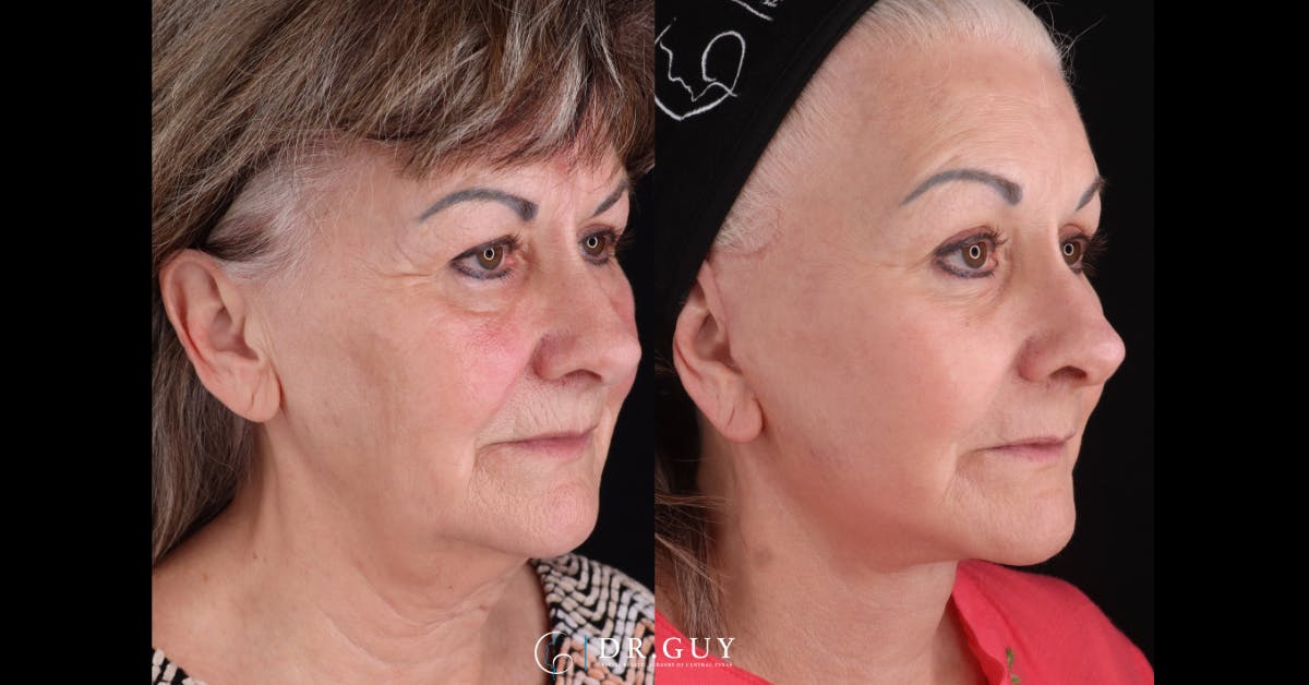 Facelift Before & After Gallery - Patient 558043 - Image 2